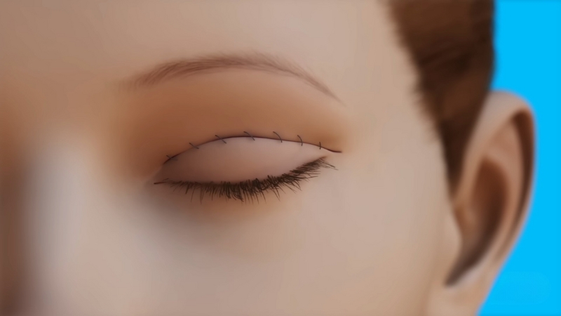 Illustration of a stitched upper eyelid after blepharoplasty surgery