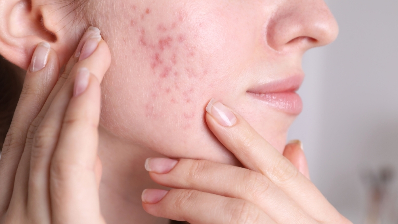 Close-up of a woman touching acne scars on her cheek