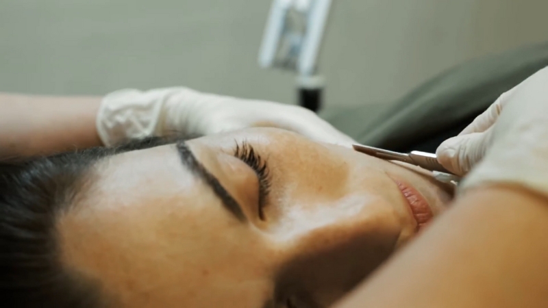 Woman receiving an epi-blading treatment with a scalpel tool on her cheek