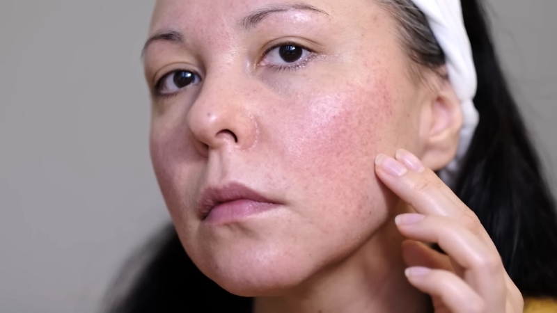Close-up of a woman checking acne scars and redness on her cheek