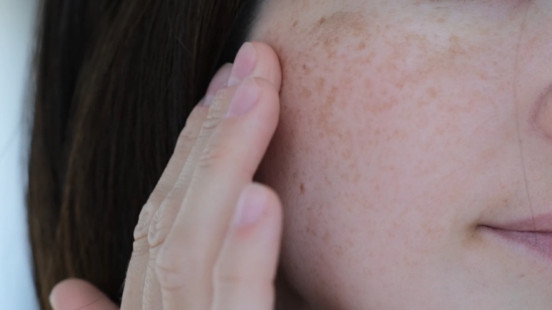 A close-up of a woman touching her cheek with visible dark spots and freckles
