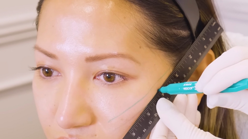 Practitioner marking cheek lines before PDO thread lifting treatment