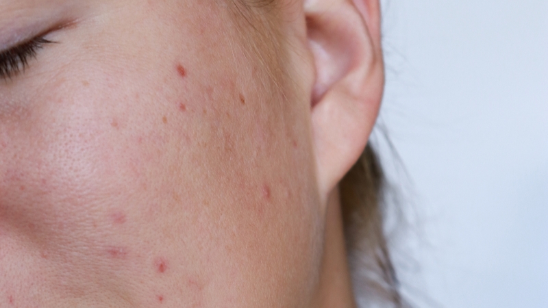 Read more about the article Rebuilding Confidence Through Scar Reduction