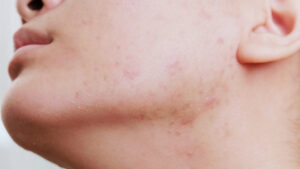 Read more about the article 7 Most Common Chronic Inflammatory Skin Disorders And How To Deal With Them