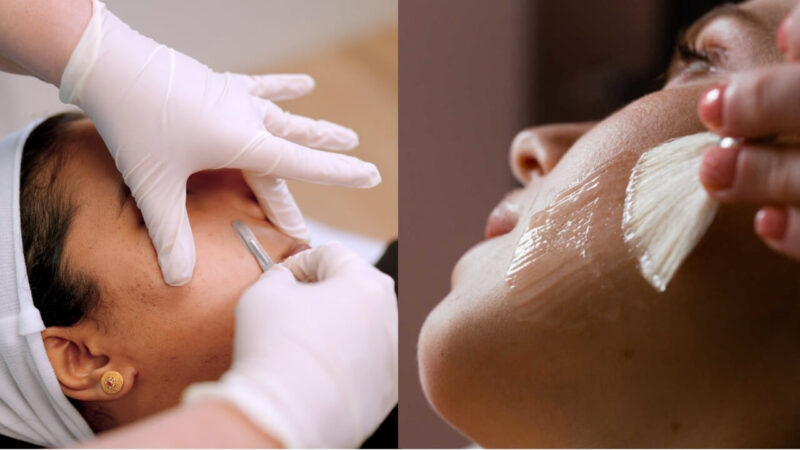Chemical Peel or Dermaplaning