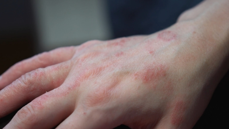 Red eczema patches on the hand with dry and irritated skin