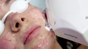 Read more about the article Intense Pulsed Light (IPL) Treatment – Benefits and Results