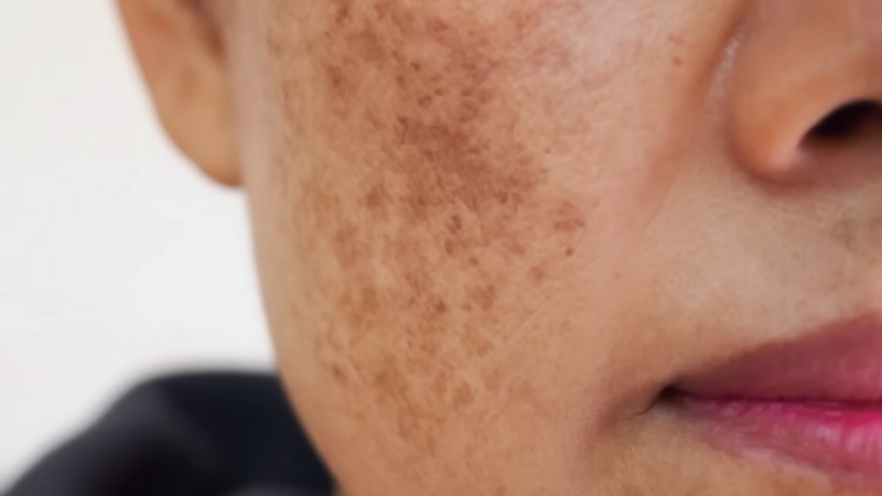 Brown melasma patches visible on the cheek and upper lip area