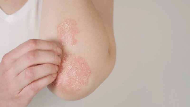 Red, scaly psoriasis plaques visible on the elbow with flaking skin
