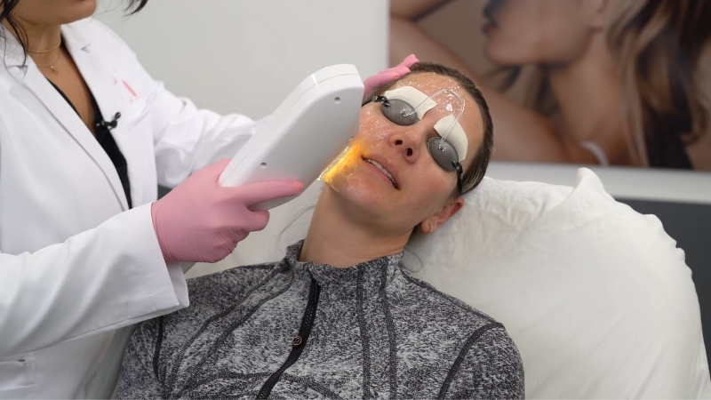 Clinician performs Intense Pulsed Light (IPL) Treatment with protective eyewear during a facial session