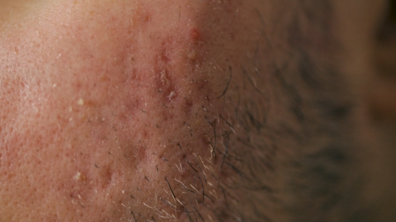 Red, flaky seborrheic dermatitis patches along the beard and facial skin