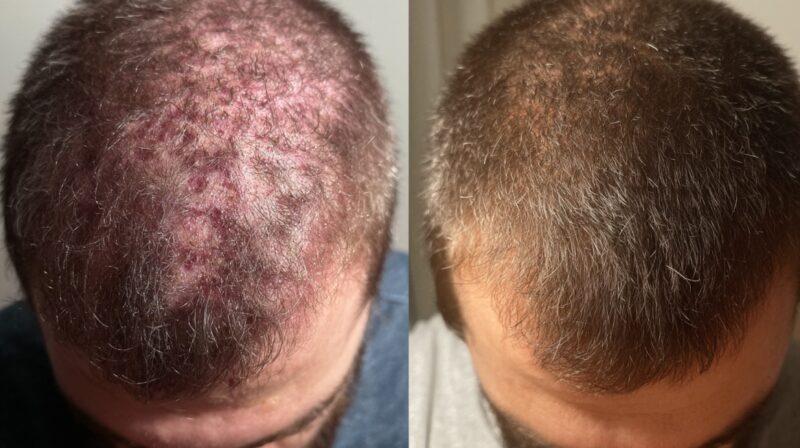 Two top-down images comparing a scalp with redness and irritation to a clearer scalp