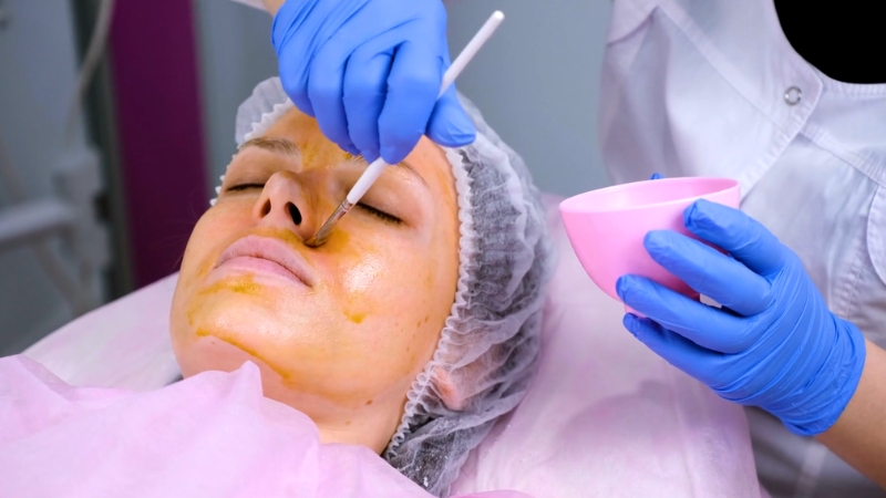 Clinician applying a chemical peel solution to a patient’s face during an aesthetic treatment