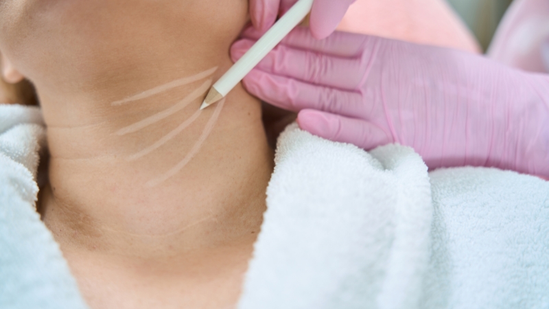 Surgeon marking the neck area before a neck lift procedure