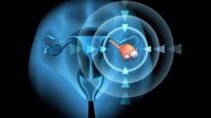 Read more about the article Laparoscopic Ovarian Cyst Surgery Recovery – Pain, Bloating, and When Exercise Can Resume